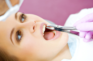 dental extractions