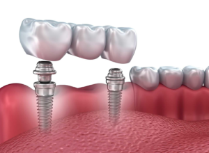 Dental Implants