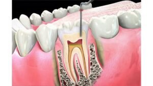 Root canal therapy