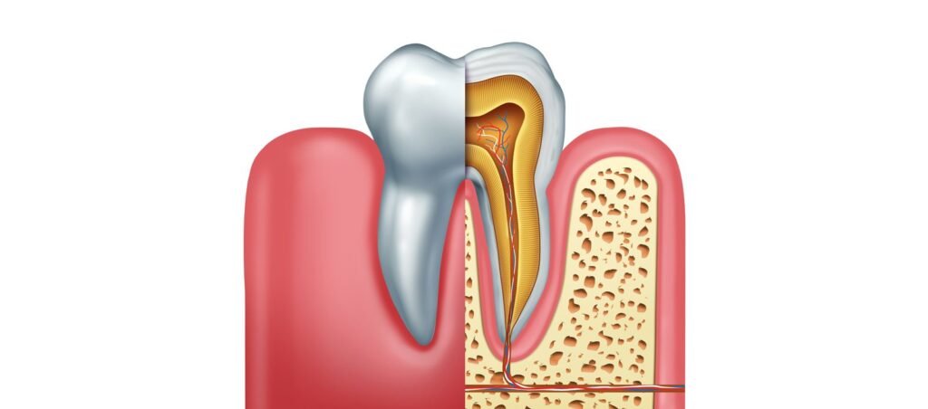 root canal