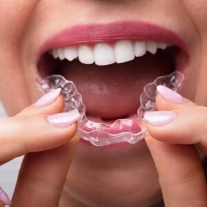 Invisalign Consultation