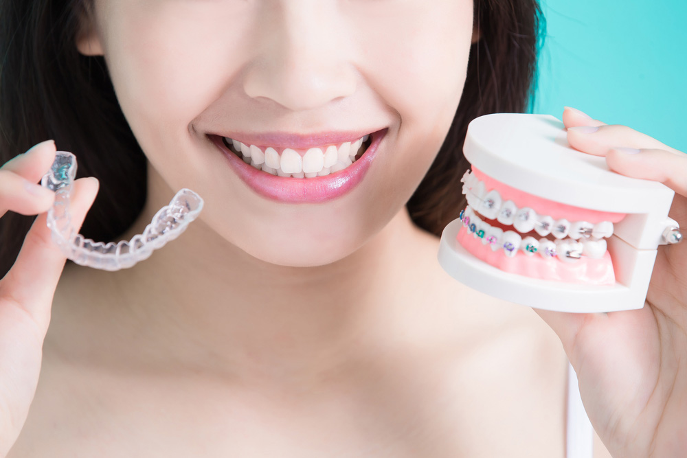 Invisalign Consultation