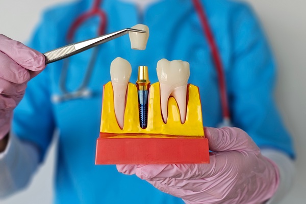 How To Care For Your New Dental Implant Restoration