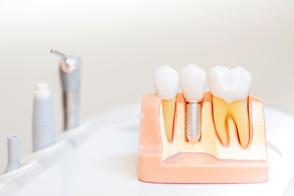 How Natural Does An Implant Crown Look?